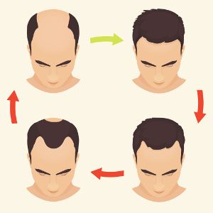 Cycle illustrant la perte de cheveux chez les hommes